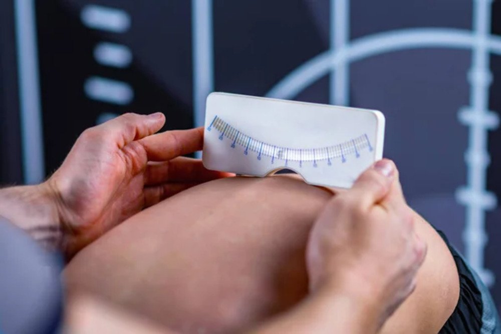 Scoliosis Screening & Management 1 Scoliosis Screening Management 1